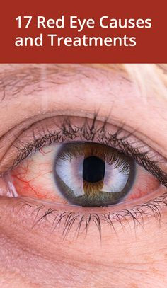 19 causes and treatments for red eyes