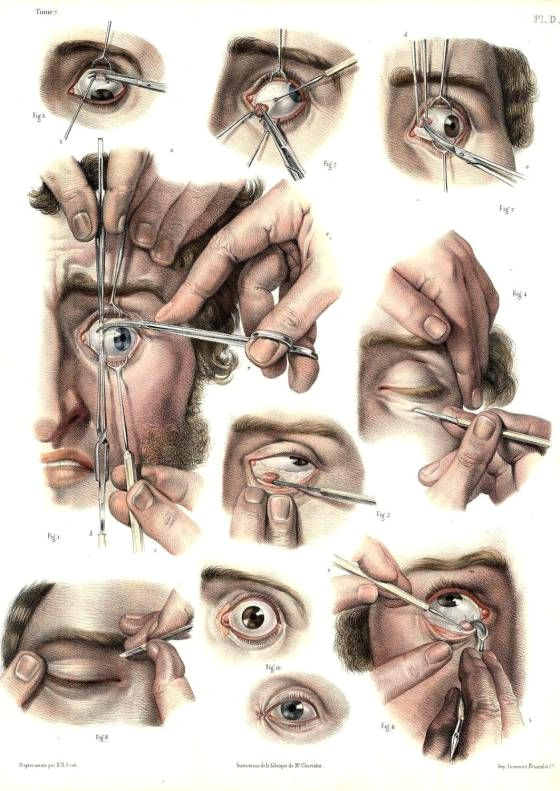 surgical technique for correcting a lazy eye from traite complet de l anatomie de l homme by jean baptiste marc bourgery 1831