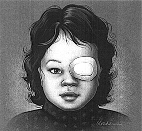 amblyopia lazy eye