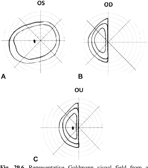 fig 29 6 representative goldmann visual field from a patient claiming a monocular visual field