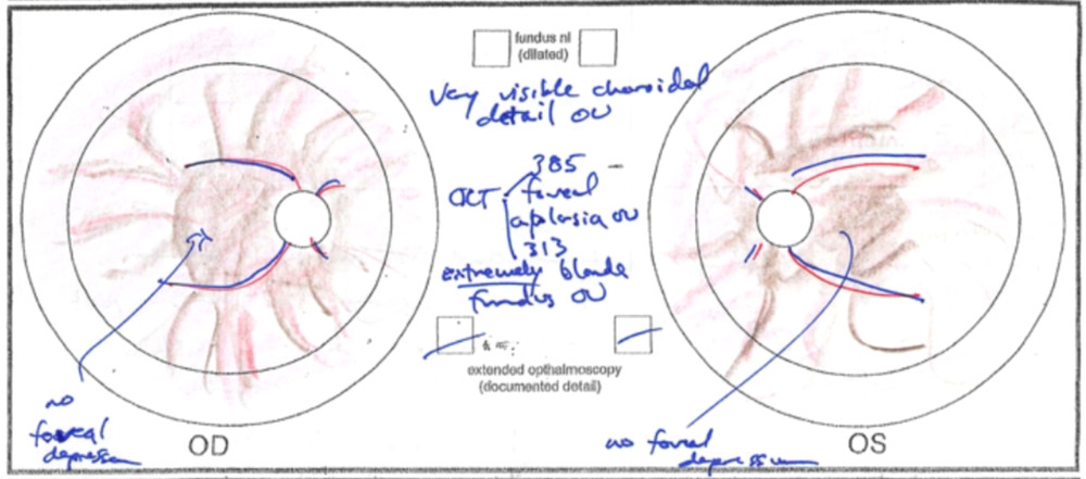 x linked ocular albinism