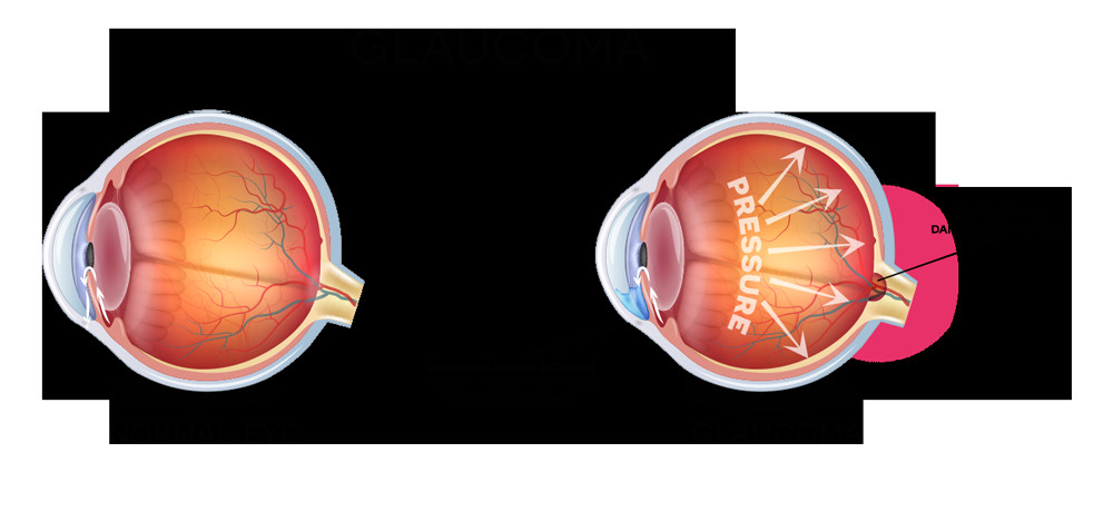 how will my physician treat my glaucoma glaucoma treatment includes medicated eye drops