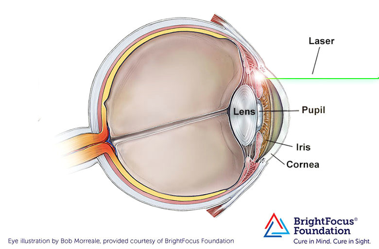 a diagram of the eye showing the process of peripheral laser iridotomy