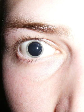 english dilated pupils after an optometrist a