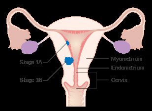 a diagram of stage ia and ib endometrial cancer