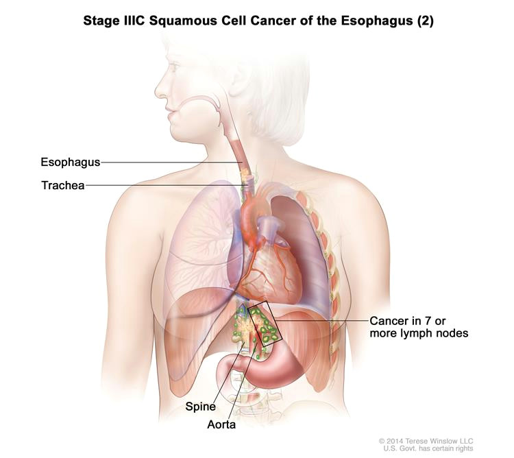 enlarge stage iiic squamous cell cancer of the esophagus 2 drawing shows cancer that