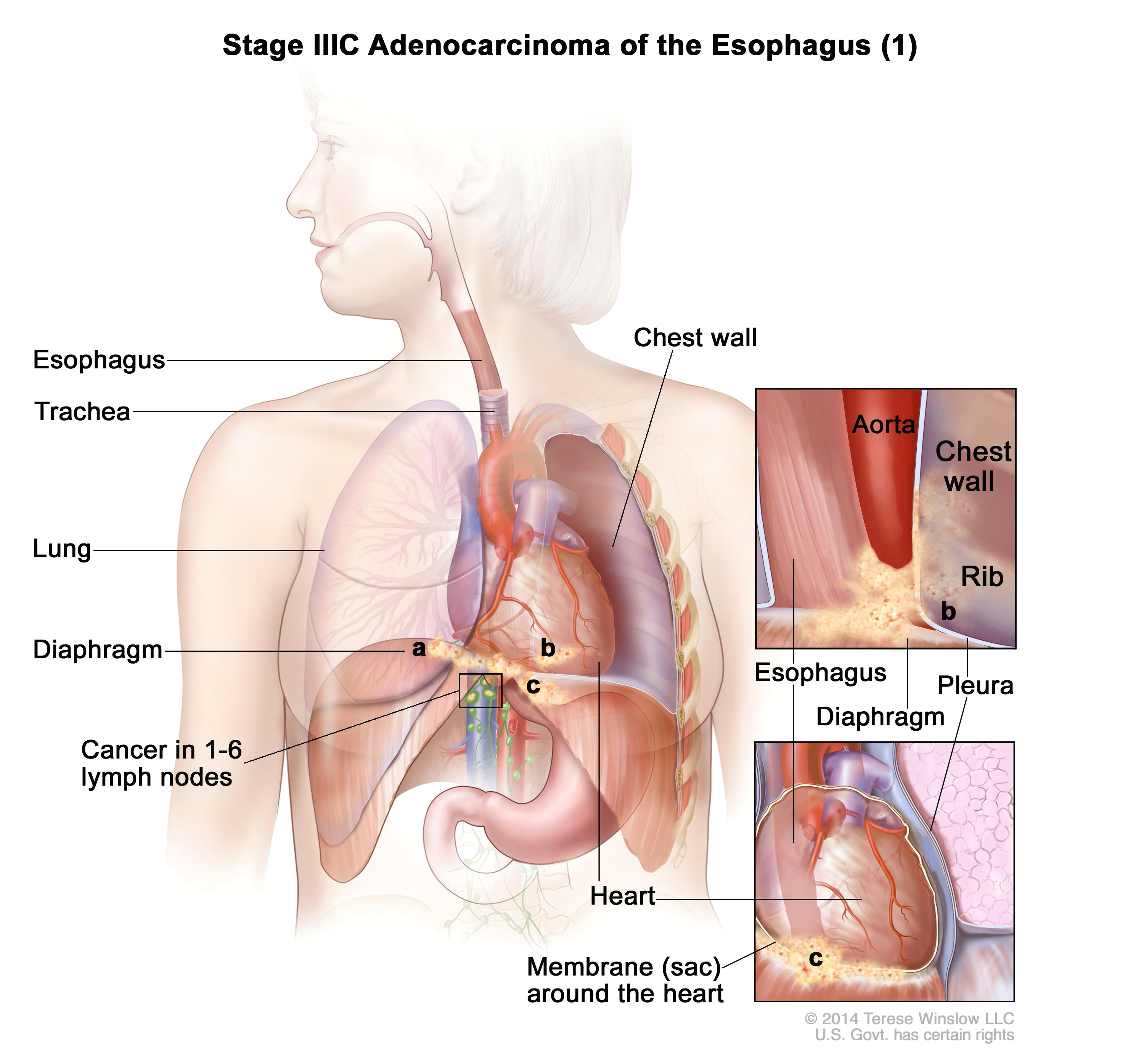 tumor or enlarge