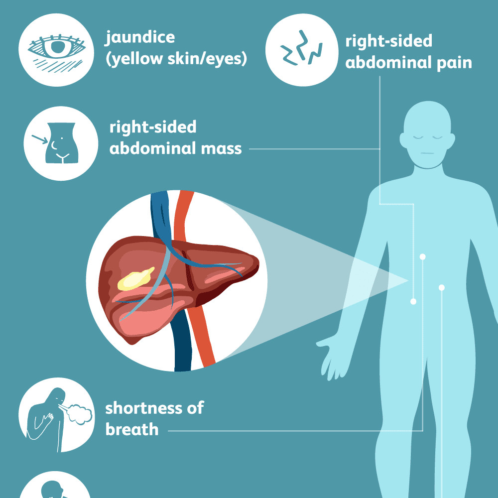 liver cancer symptoms