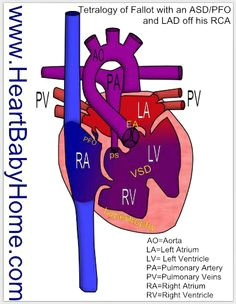 Drawing Of Heart Disease 166 Best Heart Images Congenital Heart Defect Chd Awareness