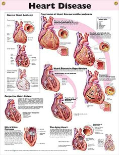 heart disease anatomy poster congestive heart failure mitral valve prolapse and the effects of an