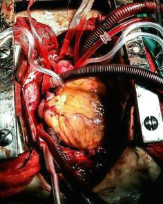 open heart surgery is amazing yes i ve had my hand on a