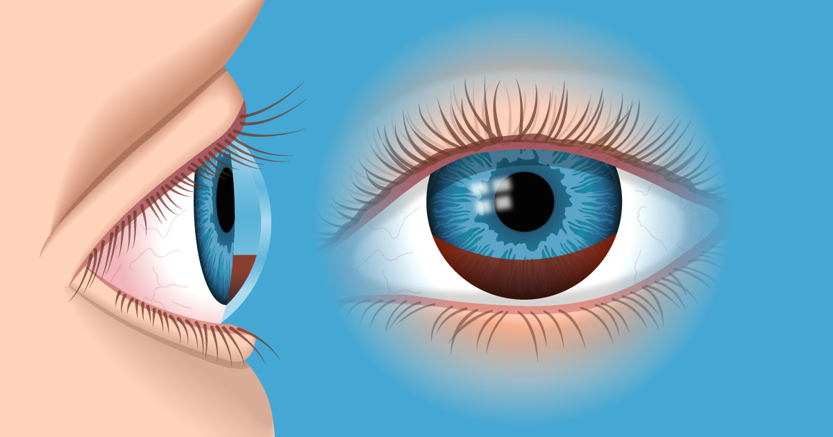 hyphema 1200x630 png