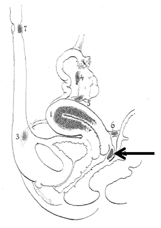 sagittal drawing of the pelvis with arrow pointing to endometriosis of the retrocervical septum cullen ts am j dis women children 1919 136