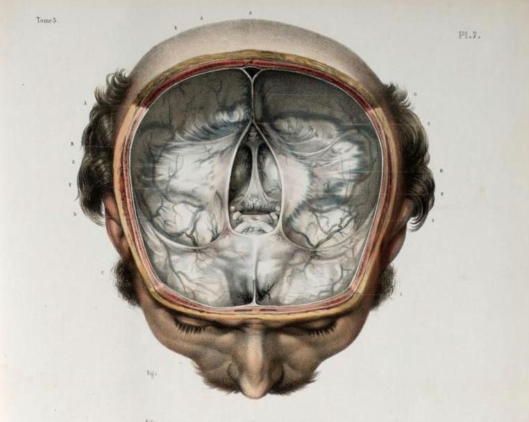 skull divided to remove anterior hemisphere brain removed to show cranial fossa and dura mater