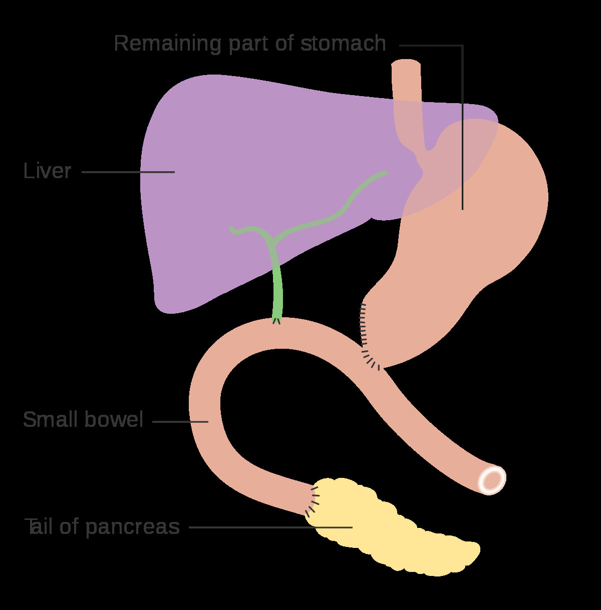 1200px diagram showing how the pancreas and bowel is joined back together after a whipple 27s operation cruk 140 svg png