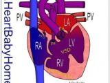 Drawing Of Heart Disease 166 Best Heart Images Congenital Heart Defect Chd Awareness