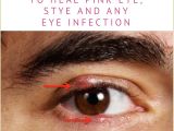 Drawing Out Eye Infection Colloidal Silver Heal Eye Infections Fast How to Use It Safely and