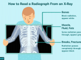 Easy X Ray Drawing X Rays Uses Procedure Results